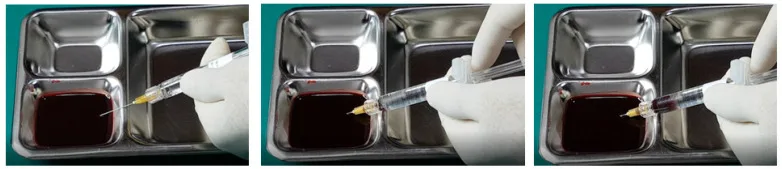 Sequência de teste de aspiração em bancada com agulha e gel de ácido hialurônico imersa em sangue — figura de estudo — Dr. Thiago Perfeito