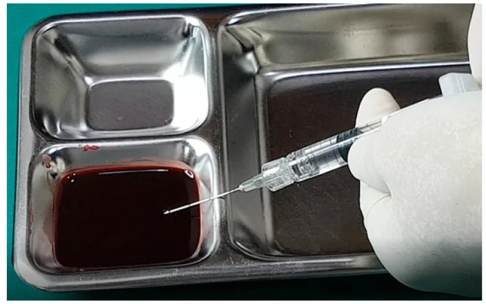 Teste de aspiração em bancada com cânula e gel de ácido hialurônico imersa em sangue — figura de estudo — Dr. Thiago Perfeito