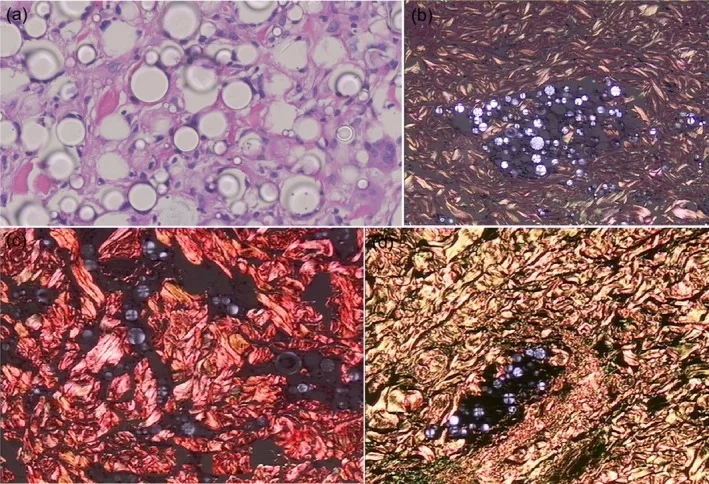 Histologia de estria abdominal com partículas de ácido poli-L-láctico entre fibras de colágeno — Dr. Thiago Perfeito