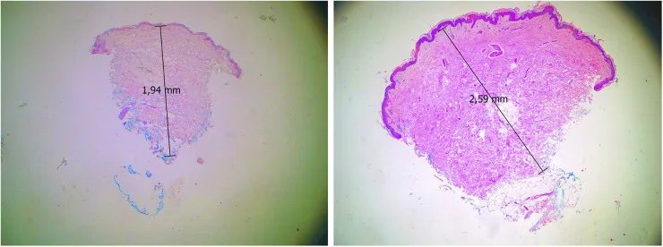 Biópsias da pele do braço coradas por hematoxilina-eosina antes e depois do ácido poli-L-láctico, com a espessura medida — Dr. Thiago Perfeito