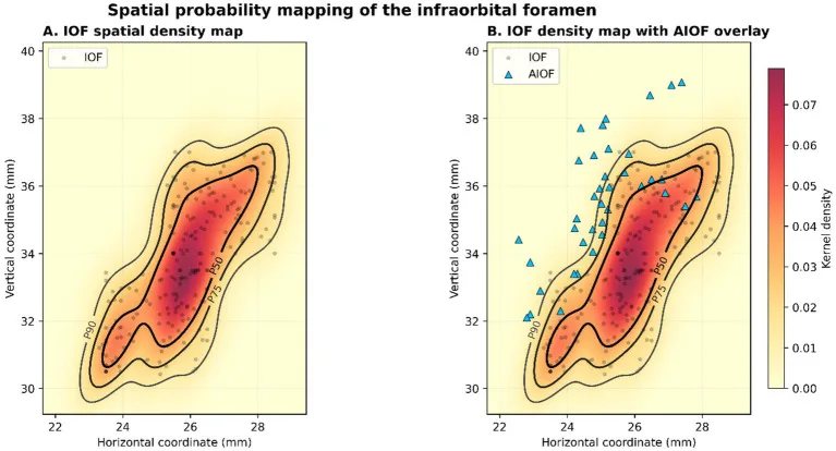 Mapa de densidade da posição do forame infraorbital com os forames acessórios sobrepostos — figura de estudo — Dr. Thiago Perfeito