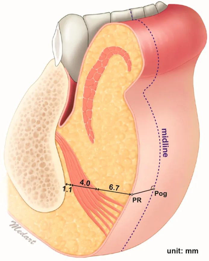 Corte sagital esquemático do queixo mostrando a profundidade do músculo mentual em relação à pele e ao osso — Dr. Thiago Perfeito