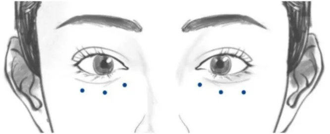 Desenho com três pontos de injeção de toxina abaixo de cada pálpebra inferior — Dr. Thiago Perfeito