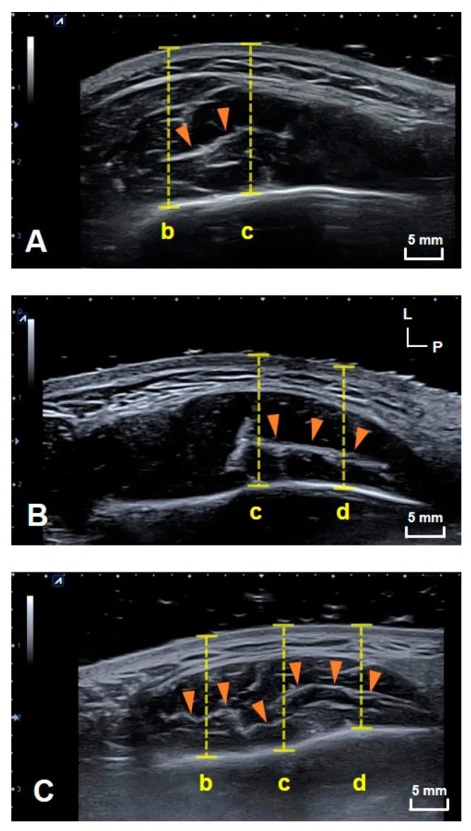 Ultrassom transversal do masseter mostrando os três padrões do tendão inferior profundo — Dr. Thiago Perfeito