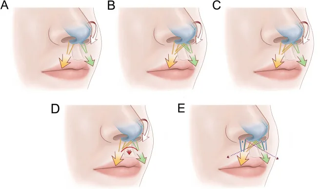 Esquema do depressor do septo e do orbicular da boca puxando a ponta do nariz para baixo — Dr. Thiago Perfeito