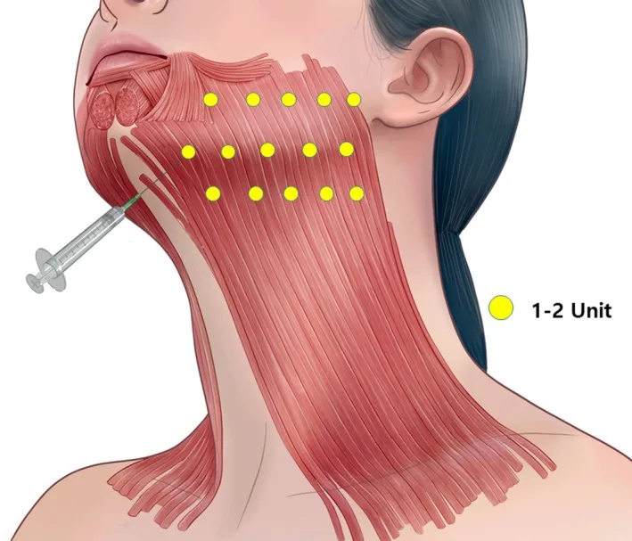 Esquema dos pontos de injeção de toxina no platisma concentrados na porção superior e na borda da mandíbula — Dr. Thiago Perfeito