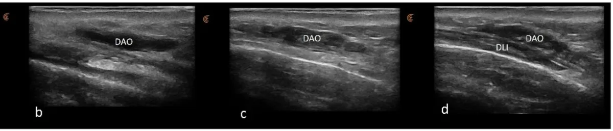 Ultrassom do depressor do ângulo da boca em três alturas com o depressor do lábio inferior abaixo — Dr. Thiago Perfeito
