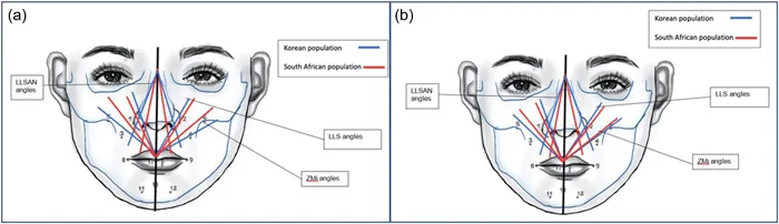 Esquema dos ângulos dos músculos elevadores do lábio em duas populações para o ponto de Yonsei — figura de estudo — Dr. Thiago Perfeito