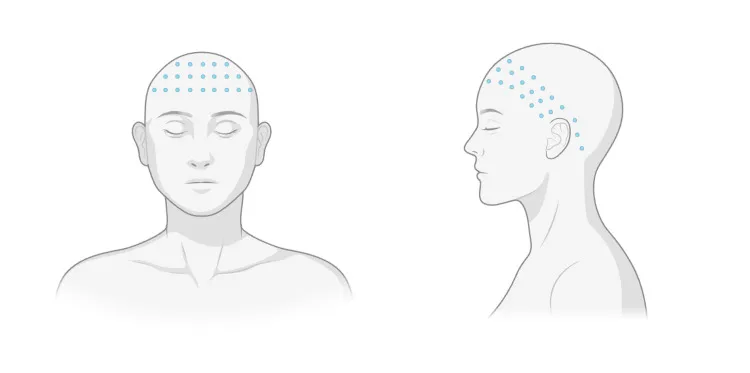 Desenho dos pontos de toxina na testa alta, linha do cabelo e região ao redor da orelha na hiperidrose craniofacial — Dr. Thiago Perfeito