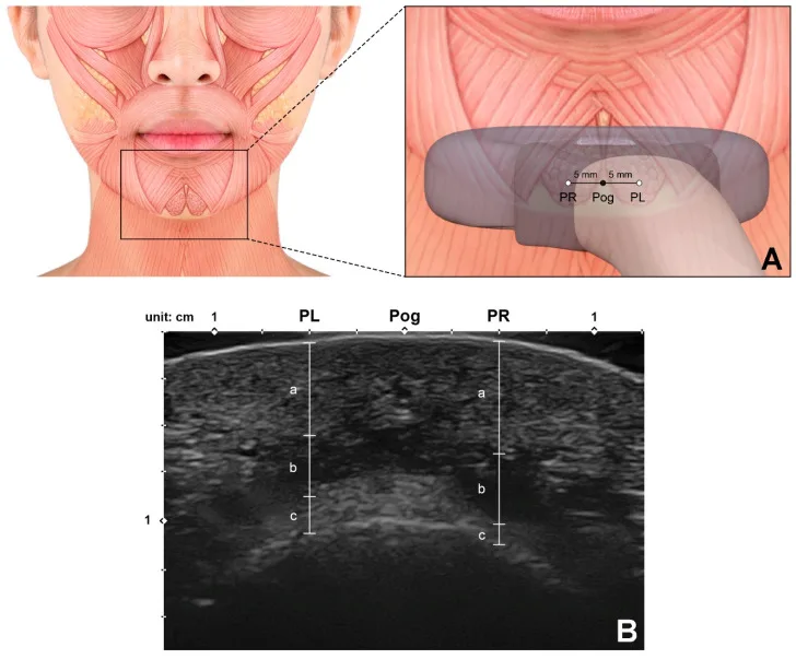 Ultrassom transversal do queixo com as camadas da pele ao osso sobre o músculo mentual — Dr. Thiago Perfeito