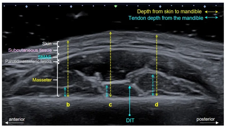 Ultrassom transversal do masseter com as camadas da pele à mandíbula e o tendão inferior profundo — Dr. Thiago Perfeito