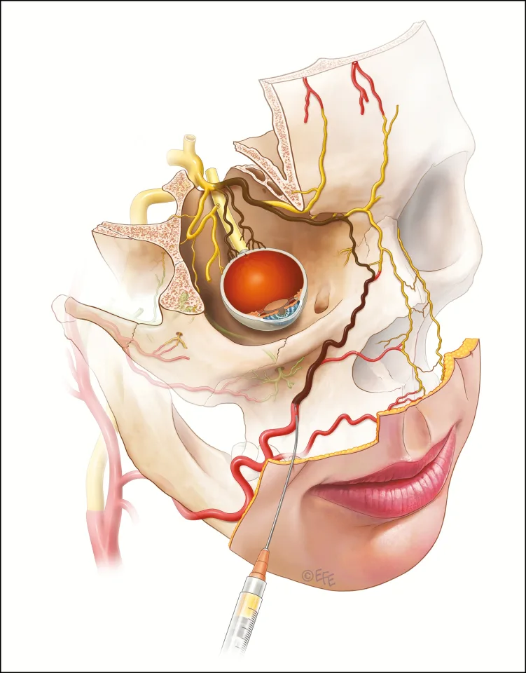 Embolia retrógrada de preenchedor da artéria facial até a artéria oftálmica — esquema anatômico — Dr. Thiago Perfeito