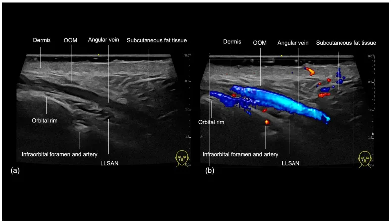 Ultrassom da região do sulco lacrimal mostrando veia angular, orbicular e forame infraorbital — figura de estudo — Dr. Thiago Perfeito
