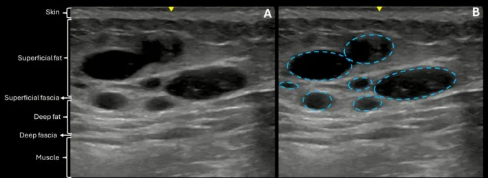 Ultrassom do glúteo com ácido hialurônico no plano subcutâneo — Dr. Thiago Perfeito