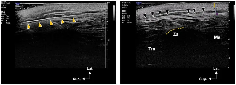 Ultrassom mostrando fio de sustentação na fáscia temporal superficial e na gordura subcutânea acima do SMAS — Dr. Thiago Perfeito
