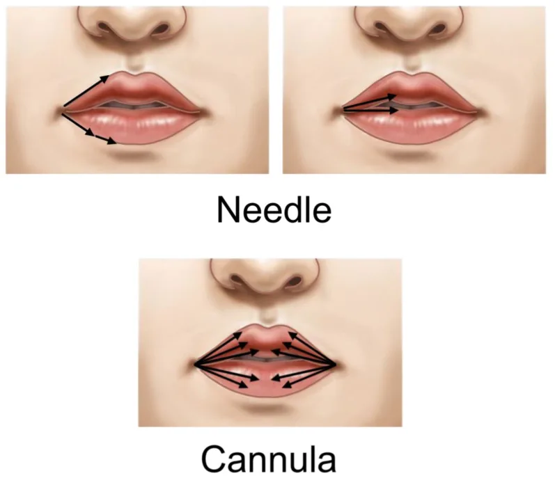 Preenchimento labial com agulha e com cânula — trajetos de injeção a partir da comissura — figura de estudo — Dr. Thiago Perfeito