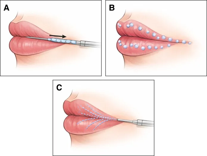 Padrões de injeção de ácido hialurônico no lábio — linear retrógrado, microdepósitos e leque — figura de estudo — Dr. Thiago Perfeito