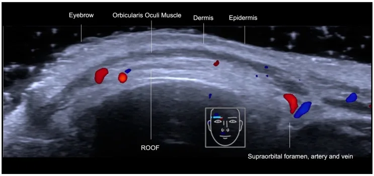 Doppler colorido do forame supraorbital com artéria e veia supraorbitais — Dr. Thiago Perfeito