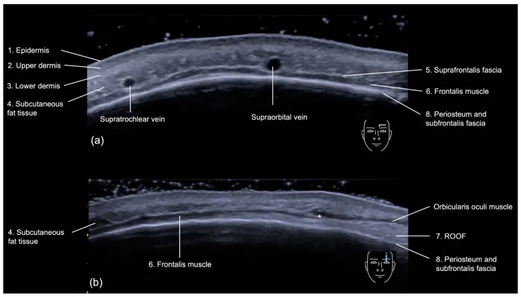 Ultrassom em escala de cinza da testa mostrando as camadas da pele ao periósteo — Dr. Thiago Perfeito