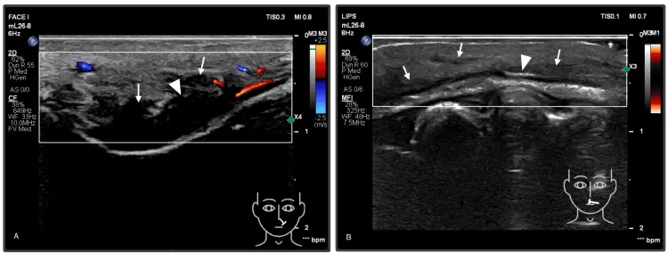 Ultrassom com Doppler mostrando oclusão arterial após preenchimento mascarada por hematoma — Dr. Thiago Perfeito