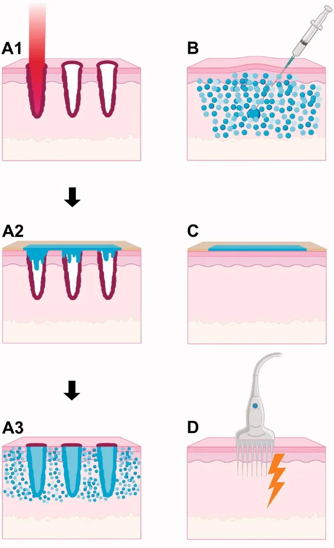Esquema da entrega de medicamento por laser fracionado comparada à injeção intradérmica e à aplicação em pele íntegra — Dr. Thiago Perfeito