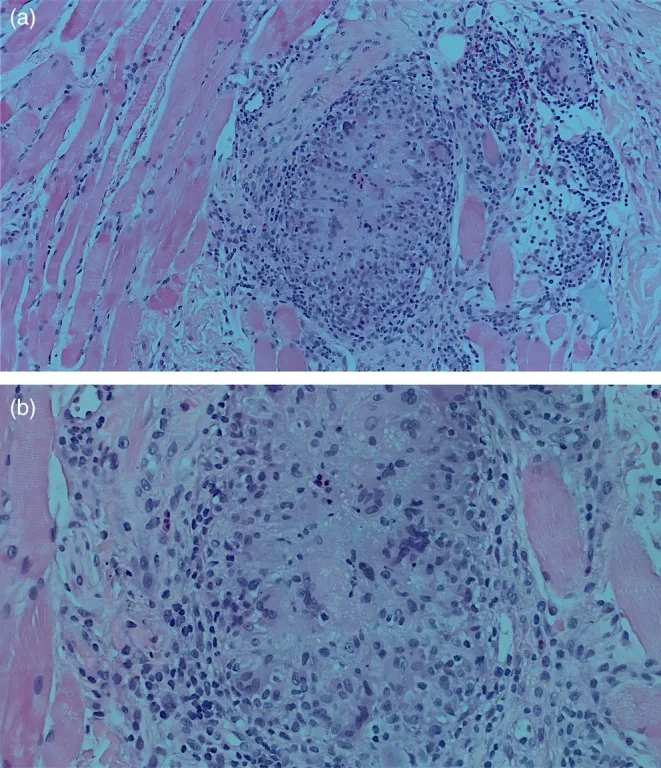 Histologia de reação granulomatosa de corpo estranho com células gigantes após preenchimento — Dr. Thiago Perfeito