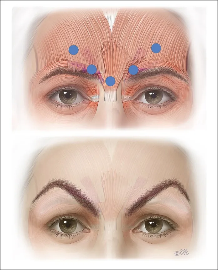 Efeito Mephisto — pontos altos sobre o frontal e elevação lateral da sobrancelha — Dr. Thiago Perfeito
