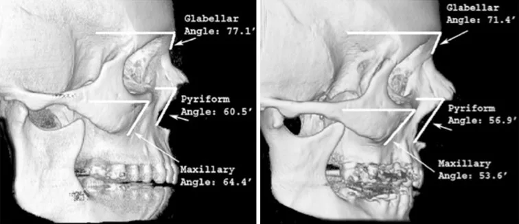 Tomografia 3D do crânio em perfil com os ângulos glabelar, piriforme e maxilar no jovem e no idoso — Dr. Thiago Perfeito