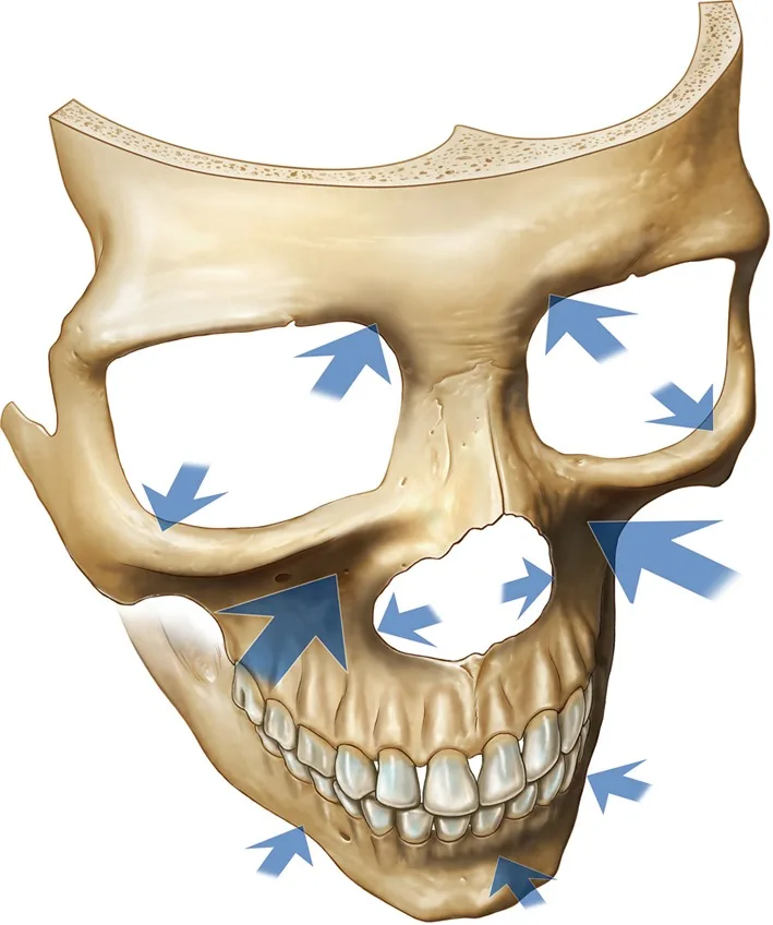 Crânio com setas nas áreas de reabsorção óssea do envelhecimento facial — Dr. Thiago Perfeito