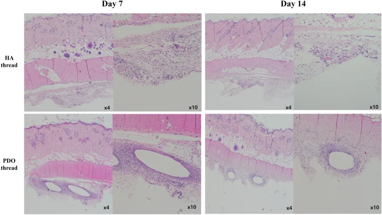 Histologia do subcutâneo com fio de PDO e fio de ácido hialurônico aos 7 e 14 dias — Dr. Thiago Perfeito