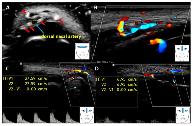 Ultrassom de alta frequência com fios de PDO ao redor da artéria dorsal do nariz e Doppler da artéria — Dr. Thiago Perfeito