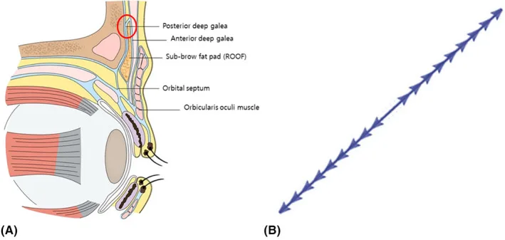 Corte sagital da sobrancelha e da órbita com as camadas da gálea e o fio espiculado — Dr. Thiago Perfeito