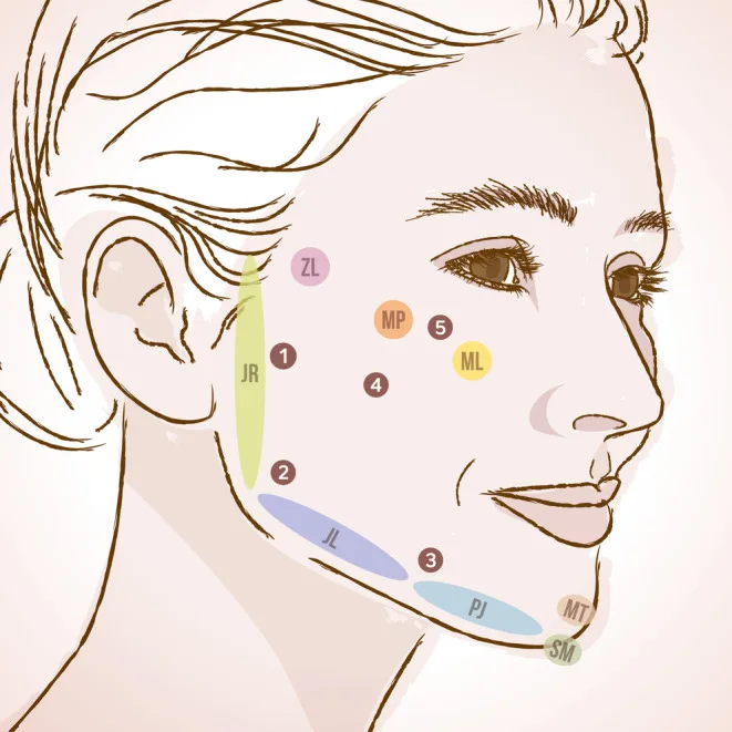Desenho da face com áreas tratadas e cinco pontos de entrada para HarmonyCa — Dr. Thiago Perfeito