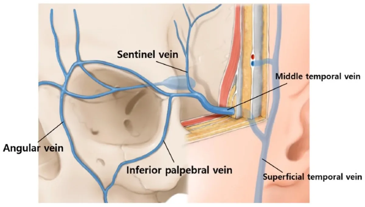 Veias da região periorbital, angular, palpebral inferior, sentinela e temporal, relevantes para hematoma na toxina botulínica — Dr. Thiago Perfeito