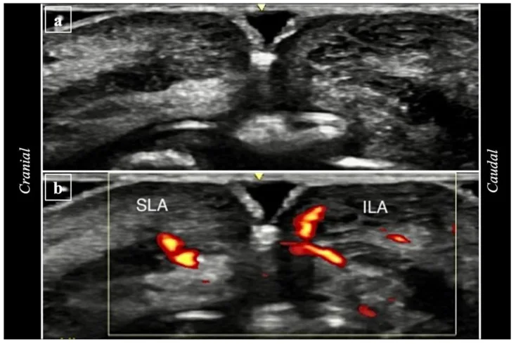 Ultrassom do lábio após técnica vertical com Doppler das artérias labiais superior e inferior — figura de estudo — Dr. Thiago Perfeito