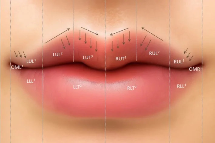 Mapa de vetores de injeção para o lábio de arco do cupido modificado, com setas verticais nos tubérculos centrais — figura de estudo — Dr. Thiago Perfeito