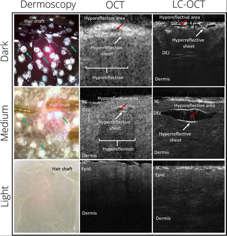 Laser em pele bronzeada — dermatoscopia e tomografia de coerência óptica de pele escura, média e clara após laser — Dr. Thiago Perfeito