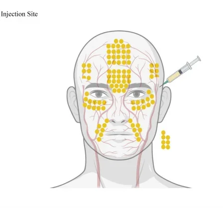 Mapa dos locais de injeção nos casos de oclusão da artéria oftálmica após enxertia facial de gordura — Dr. Thiago Perfeito