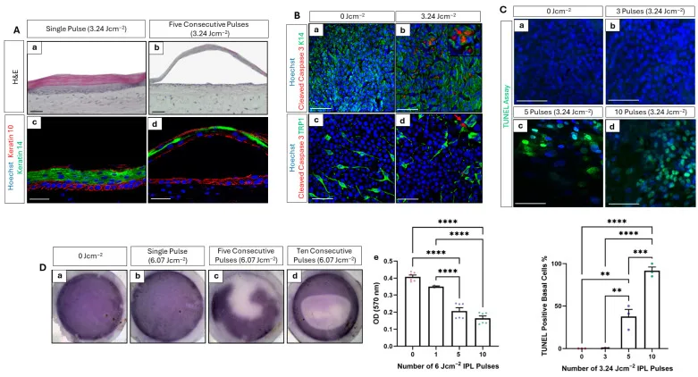 Luz intensa pulsada — histologia de pele pigmentada após um pulso e após cinco pulsos consecutivos — Dr. Thiago Perfeito