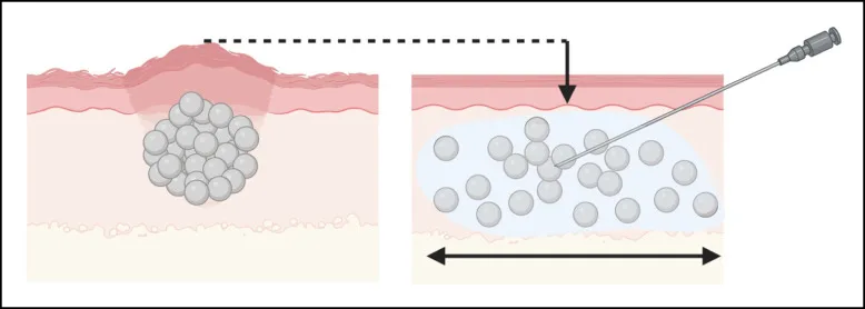 Esquema de microesferas acumuladas em nódulo e dispersas no tecido — Dr. Thiago Perfeito