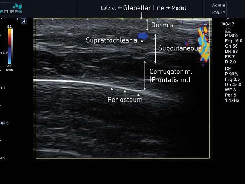 Ultrassom com Doppler da glabela — artéria supratroclear no subcutâneo acima do músculo corrugador — Dr. Thiago Perfeito