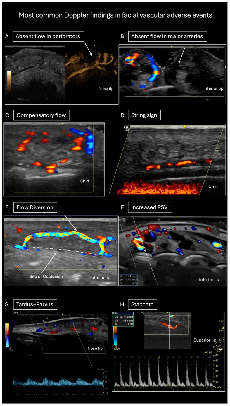 Achados de ultrassom com Doppler em oclusão vascular por preenchedor: ausência de fluxo, fluxo compensatório e sinal da corda — Dr. Thiago Perfeito