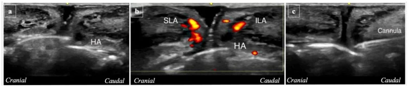 Ultrassom do lábio durante preenchimento: gel de ácido hialurônico, artérias labiais ao Doppler e cânula — figura de estudo — Dr. Thiago Perfeito