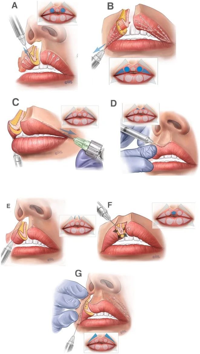 Sequência de vetores de injeção no lábio superior na técnica Multi Vector — figura de estudo — Dr. Thiago Perfeito