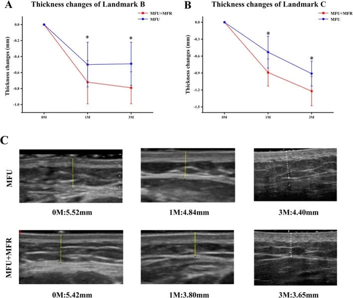 Variação da espessura da gordura subcutânea medida ao ultrassom após ultrassom microfocado com e sem radiofrequência microagulhada — Dr. Thiago Perfeito
