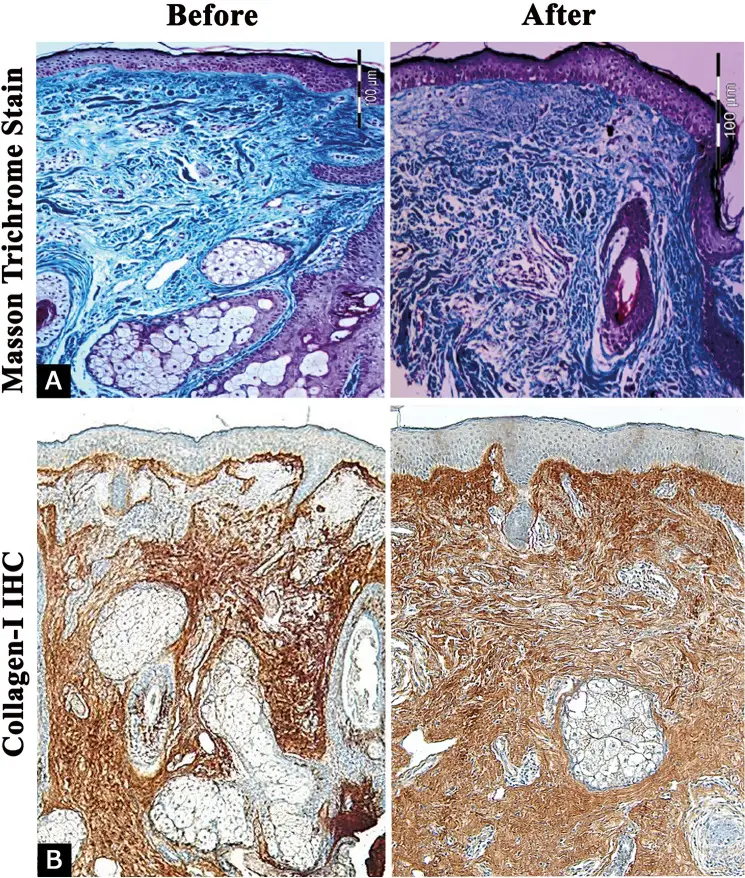 Histologia da pele antes e depois de três sessões de microagulha com radiofrequência sublativa, com coloração de Masson e imuno-histoquímica de colágeno tipo I — Dr. Thiago Perfeito