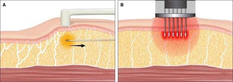 Planos de ação da radiofrequência bipolar e da radiofrequência microagulhada fracionada na pele e na gordura — Dr. Thiago Perfeito