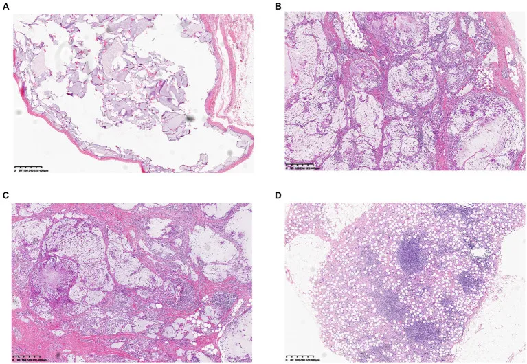 Histologia de nódulo associado a biofilme após preenchimento — infiltrado inflamatório ao redor do gel — Dr. Thiago Perfeito