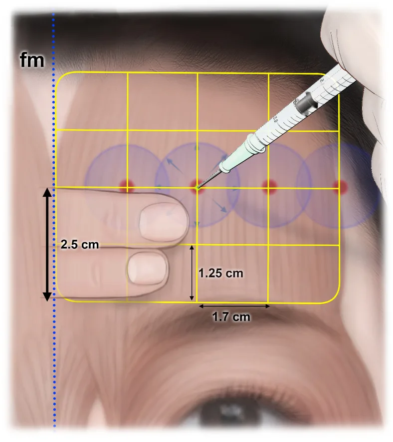 Quatro pontos de injeção de toxina no frontal propostos com base na inervação — Dr. Thiago Perfeito