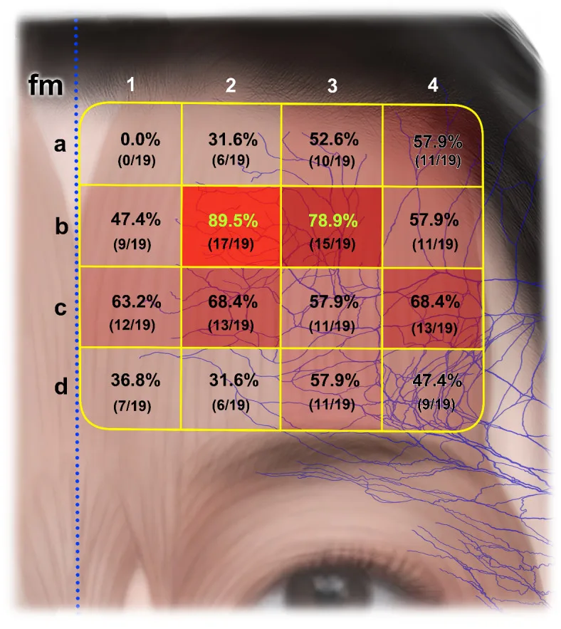 Mapa da prevalência de terminações nervosas no músculo frontal em 16 áreas — Dr. Thiago Perfeito